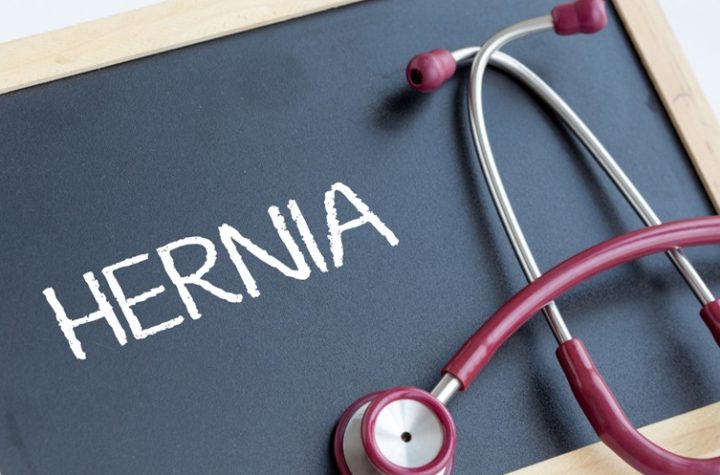 Guide on Incisional Hernias