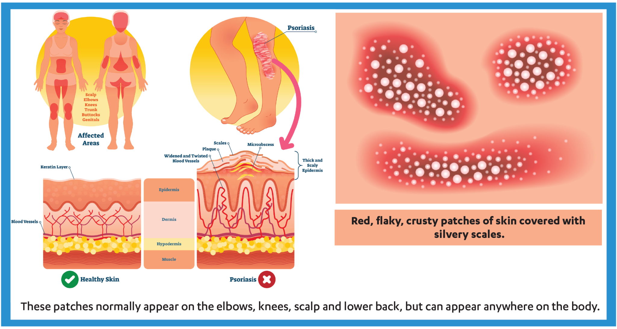 Genital Psoriasis: Causes, Signs, and Symptoms - NVT Health