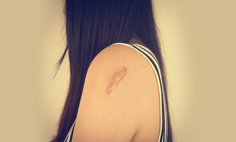 EARLY SIGNS OF A KELOID: HOW TO SPOT ONE FORMING BEFORE IT GROWS LARGE