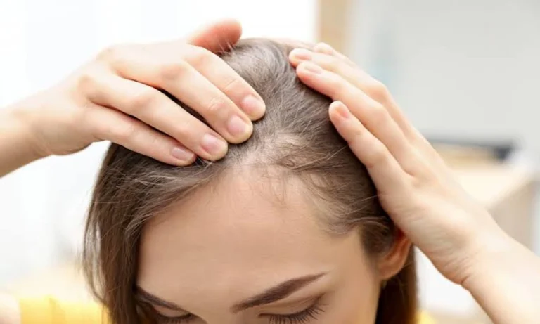 Alopecia Areata Treatment: Reasons Why Proper Assessment Matters